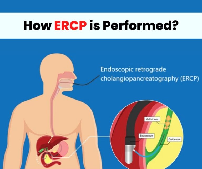 What is ERCP? How ERCP is performed?